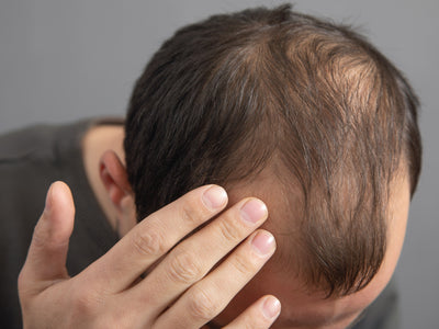 Hair Loss